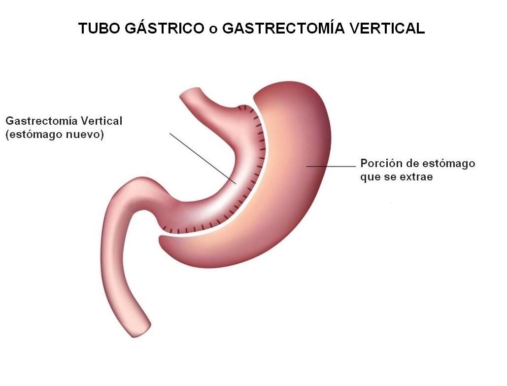 banda gástrica